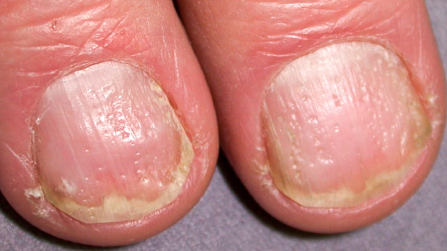 pitted indents on fingernails