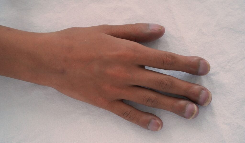 Right hand of patient with congenital cyanotic heart disease on white background. Typical characteristic for clubbing fingers. Focus on the fingers.