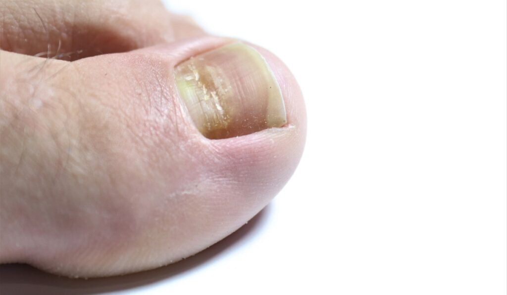 Beau's lines are deep grooved lines that run from side to side on the fingernail or the toenail.They may look like indentations or ridges in the nail plate. May be caused by a lack of Zinc / Calcium.