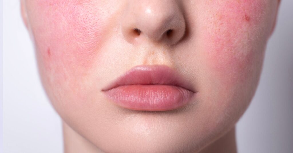 rosacea couperose redness skin, red