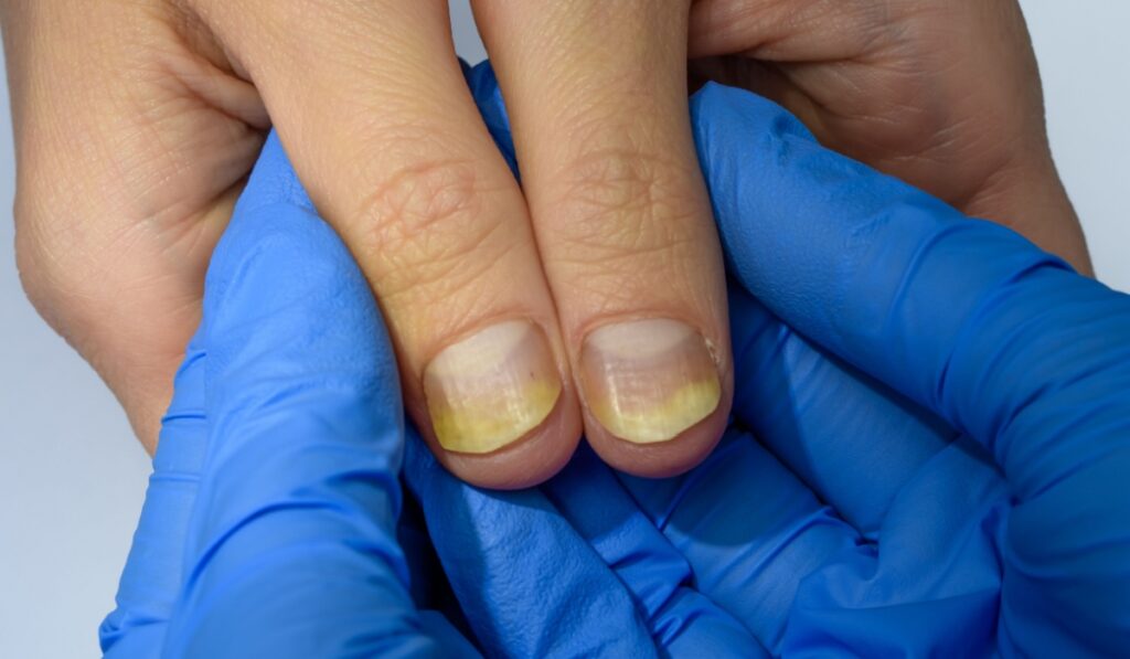 Nail psoriasis disease close up, examination by a dermatologist