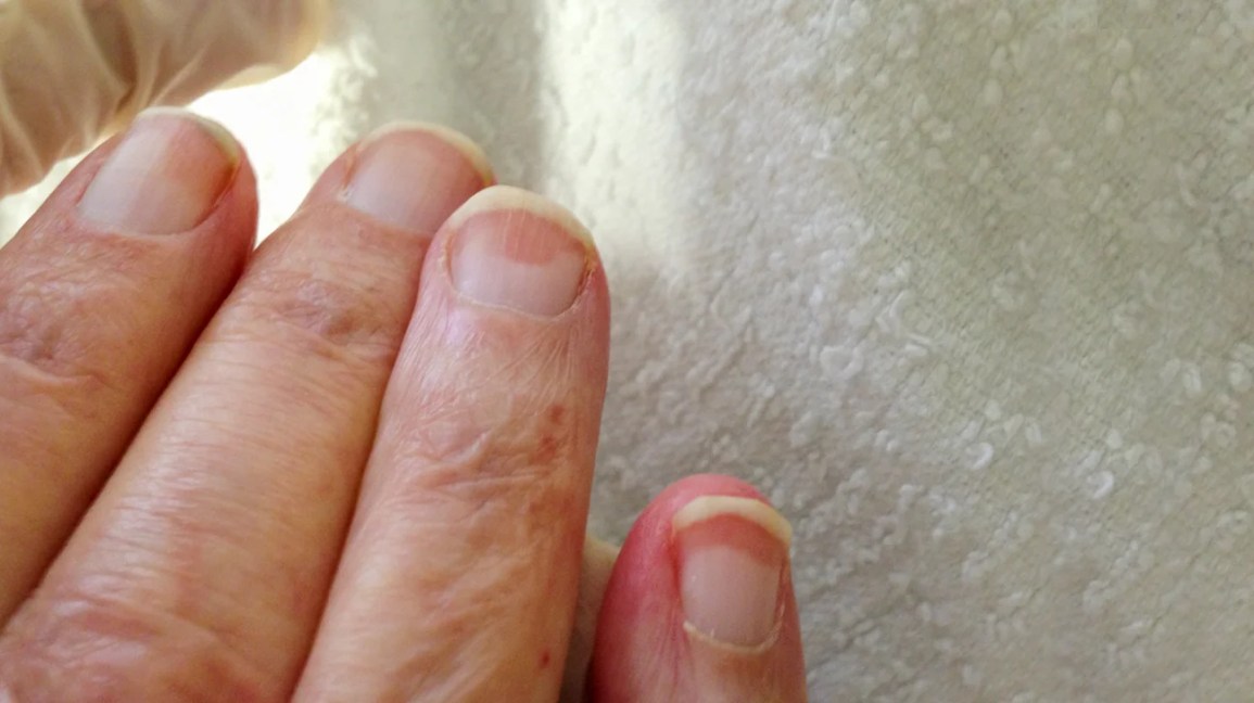 Terry's nails symptom on a right hand