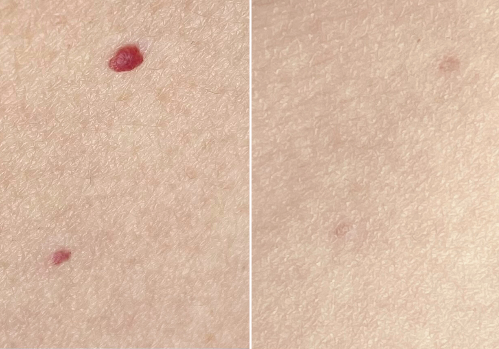 Cherry Angioma Removal - Loud Skin Clinic Westhoughton, Bolton | Hair Removal, Skin Tag, Rosacea