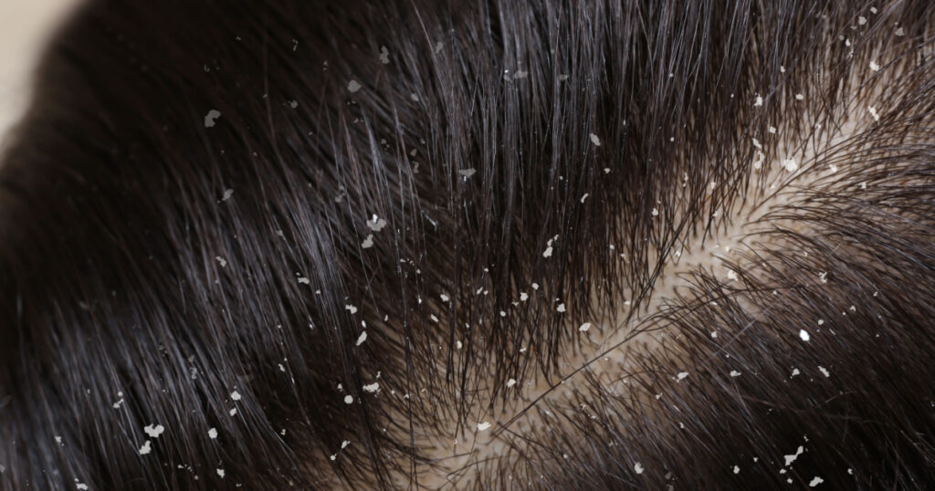 Woman with dandruff in her dark hair, closeup view