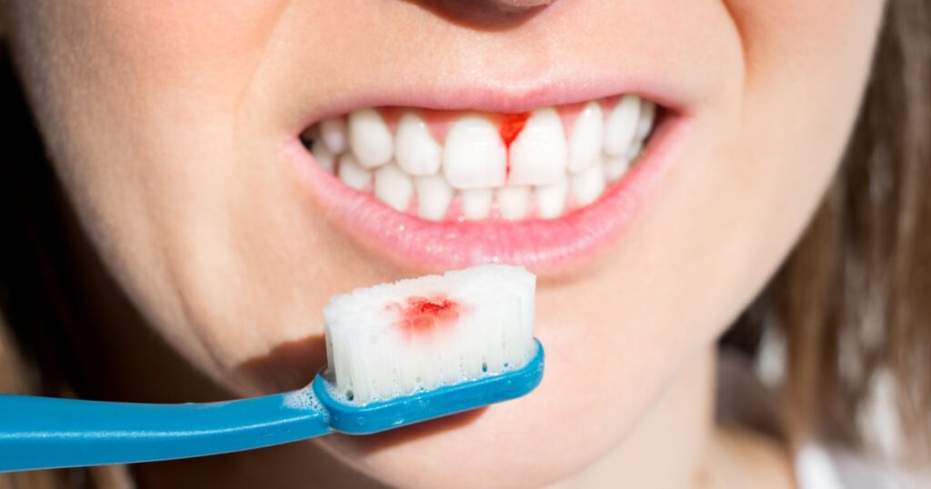 Woman with bleeding gums during teeth brushing. Hard toothbrush problem. Periodontal disease, avitaminosis, gingivitis, scurvy