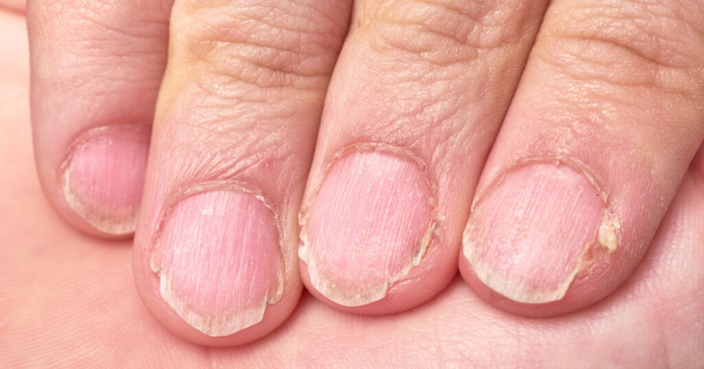Hand of a 9 year old boy showing his brittle fingernails, nail disease, extreme close up
