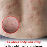 His whole body was itchy, he thought it was an allergy and was diagnosed