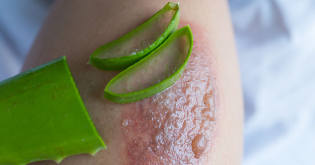 Aloe vera treatment in the blisters caused by a fire.