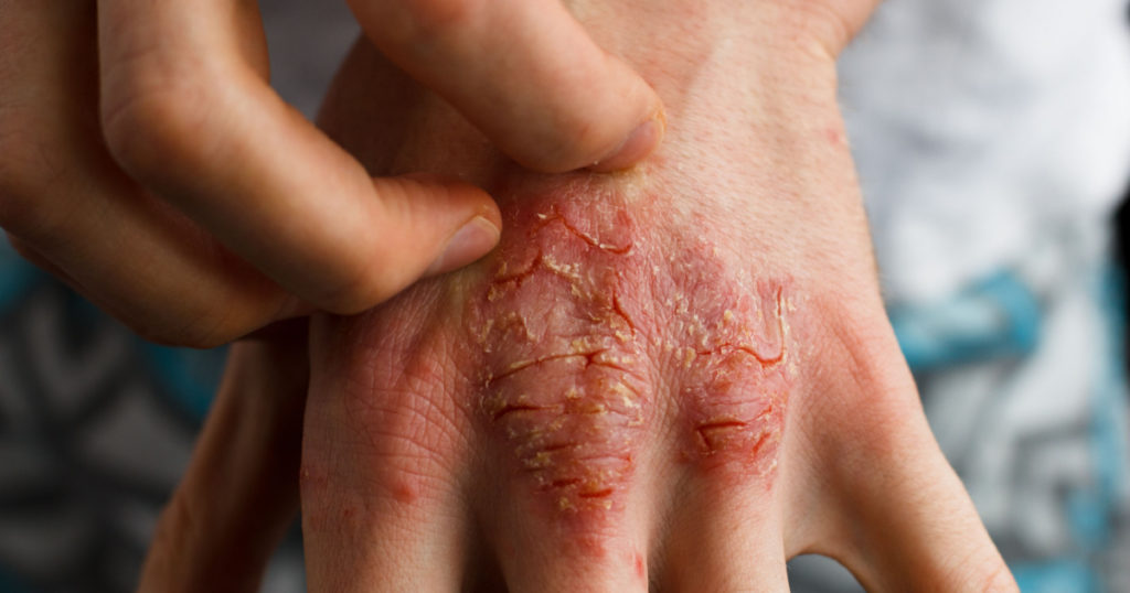 applying an emollient to dry flaky skin as in the treatment of psoriasis, eczema and other dry skin conditions