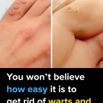 Say Goodbye to Skin Tags and Warts: Easy Removal with Hydrogen Peroxide