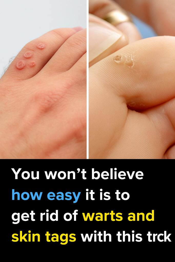 Say Goodbye to Skin Tags and Warts: Easy Removal with Hydrogen Peroxide