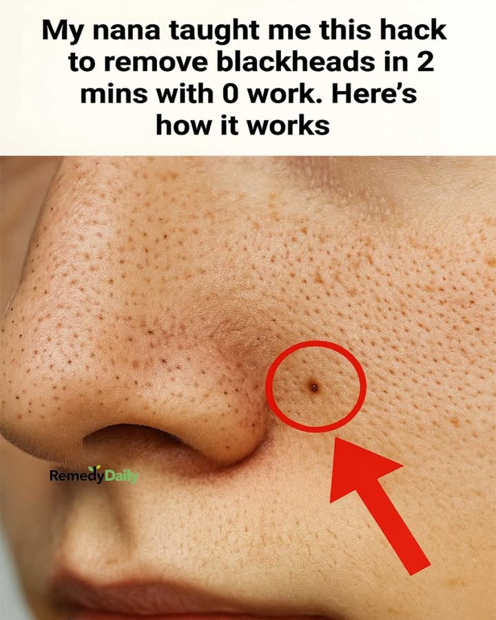 My nana taught me this hack to remove blackheads in 2 mins with 0 work. Here’s how it works