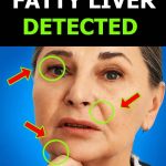 Everyone with fatty liver has this in common! A hidden sign you should know about.