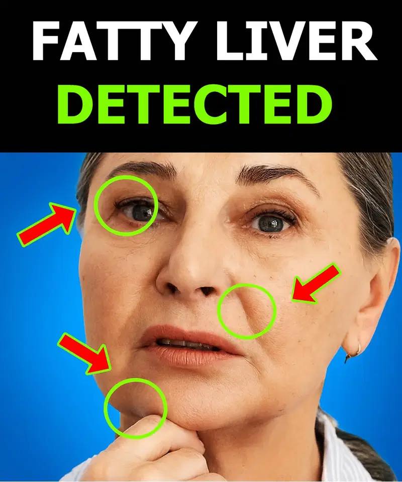 Everyone with fatty liver has this in common! A hidden sign you should know about.