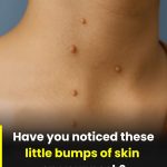 The Most Common Spots for Skin Tags and Why They Form There