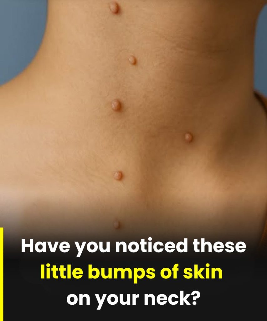 The Most Common Spots for Skin Tags and Why They Form There