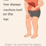 Your legs are screaming “HELP!”: 5 warning signs from your liver