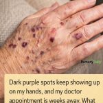 Dark purple spots keep showing up on my hands, and my doctor appointment is weeks away. What should I do in the meantime?