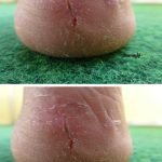 My heels are splitting open—no lotion helps. What else can I do? Should I see doc?