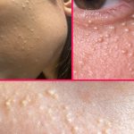 White Bumps on the Skin: Causes, Natural Solution, and Practical Tips