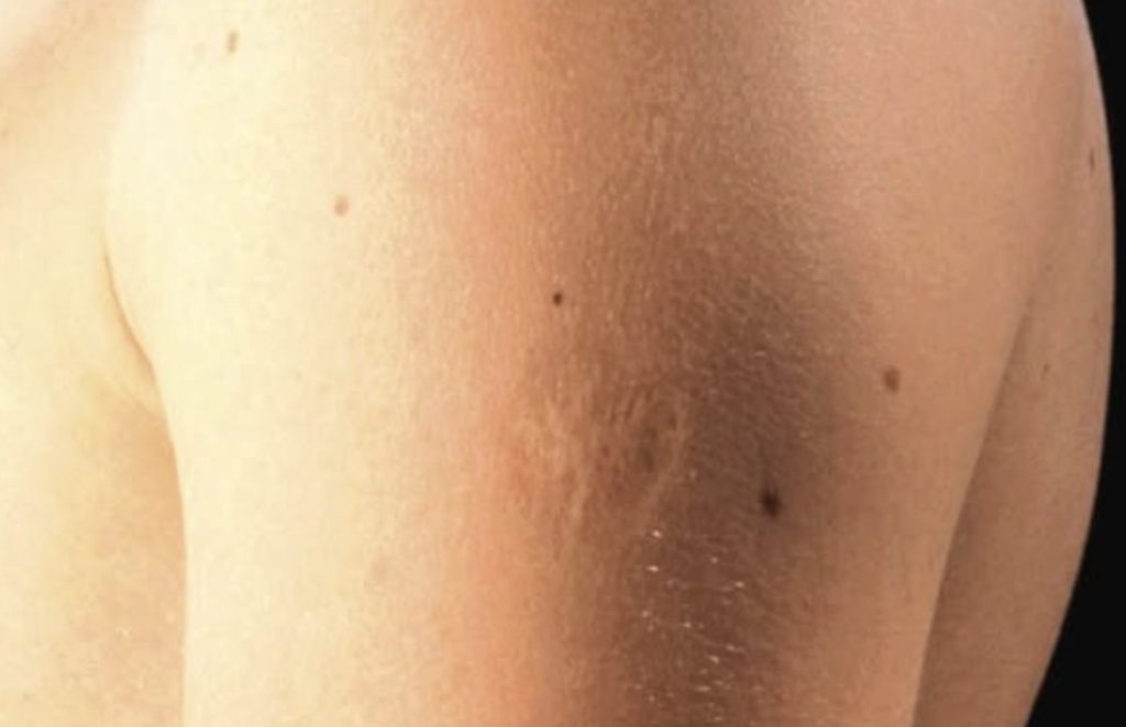 Smallpox vaccine scars: What they look like and why