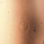 Smallpox vaccine scars: What they look like and why