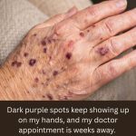Dark purple spots keep showing up on my hands, and my doctor appointment is weeks away. What should I do in the meantime?