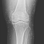 Doctors find “gold mine” in woman’s knees