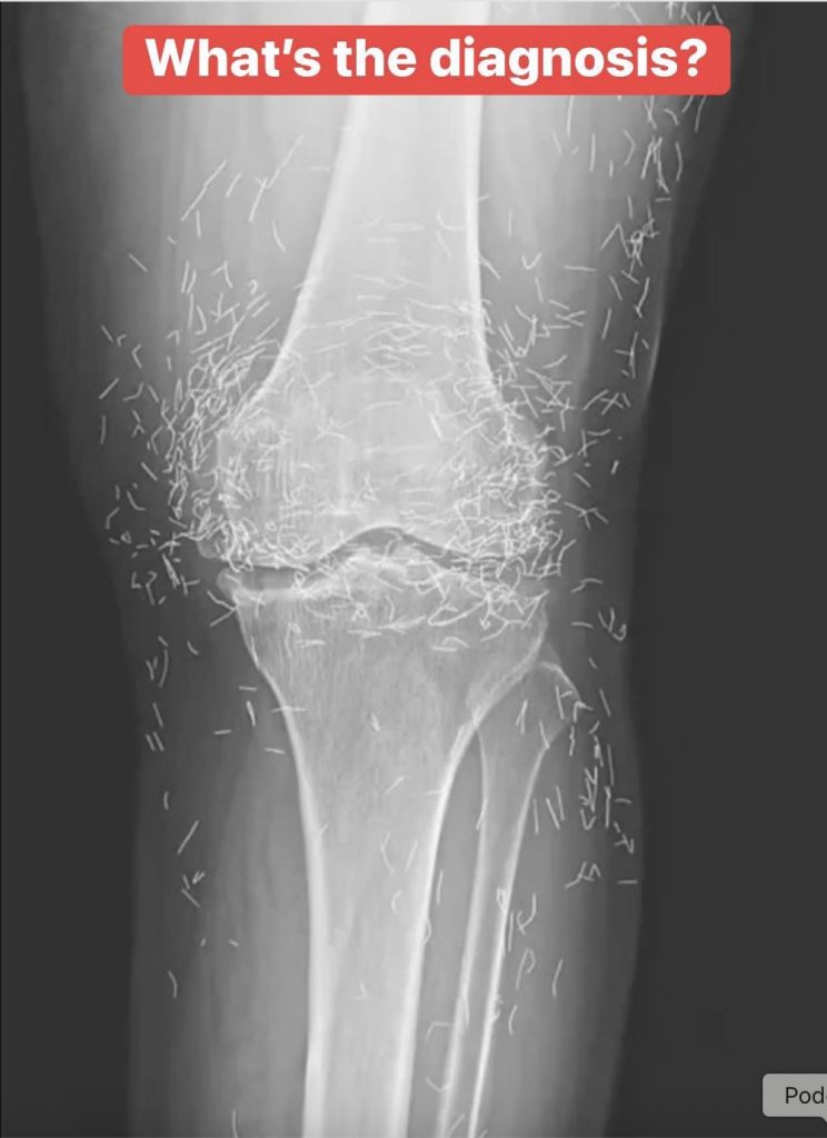 Doctors find “gold mine” in woman’s knees