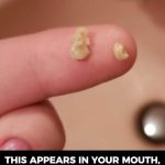Here’s what you need to know about tonsil stones – the weird pimple-like growths in your throat