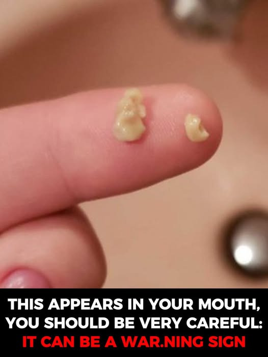 Here’s what you need to know about tonsil stones – the weird pimple-like growths in your throat