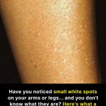 Have you noticed small white spots on your arms or legs… and you don’t know what they are?
