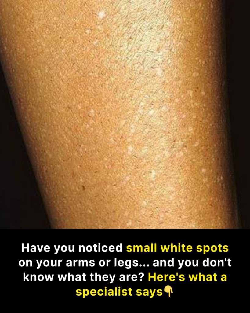Have you noticed small white spots on your arms or legs… and you don’t know what they are?
