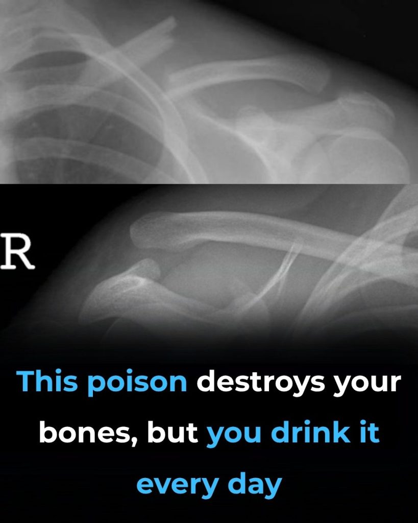 This Drink Will Destroy Your Bones From The Inside But Everyone Drinks It Anyway