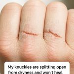 My knuckles are splitting open from dryness and won’t heal, and my appointment is weeks away. What is this?