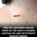 Why do I get flesh-colored moles on my neck or armpits, and how do I get rid of them? Experts explain.