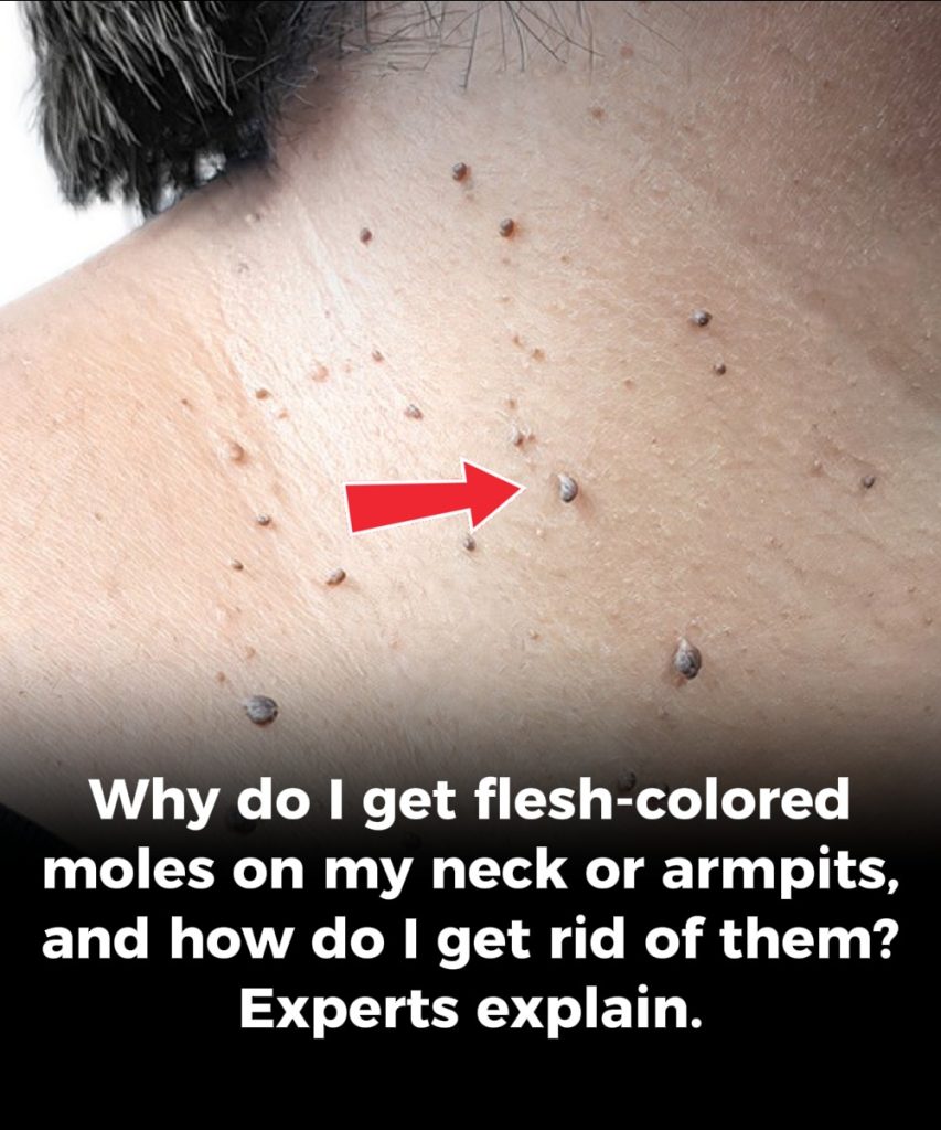 Why do I get flesh-colored moles on my neck or armpits, and how do I get rid of them? Experts explain.