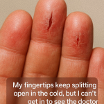 My fingertips keep splitting open in the cold, but I can’t get in to see the doctor anytime soon. What can I do now?