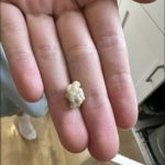 Here’s what you need to know about tonsil stones