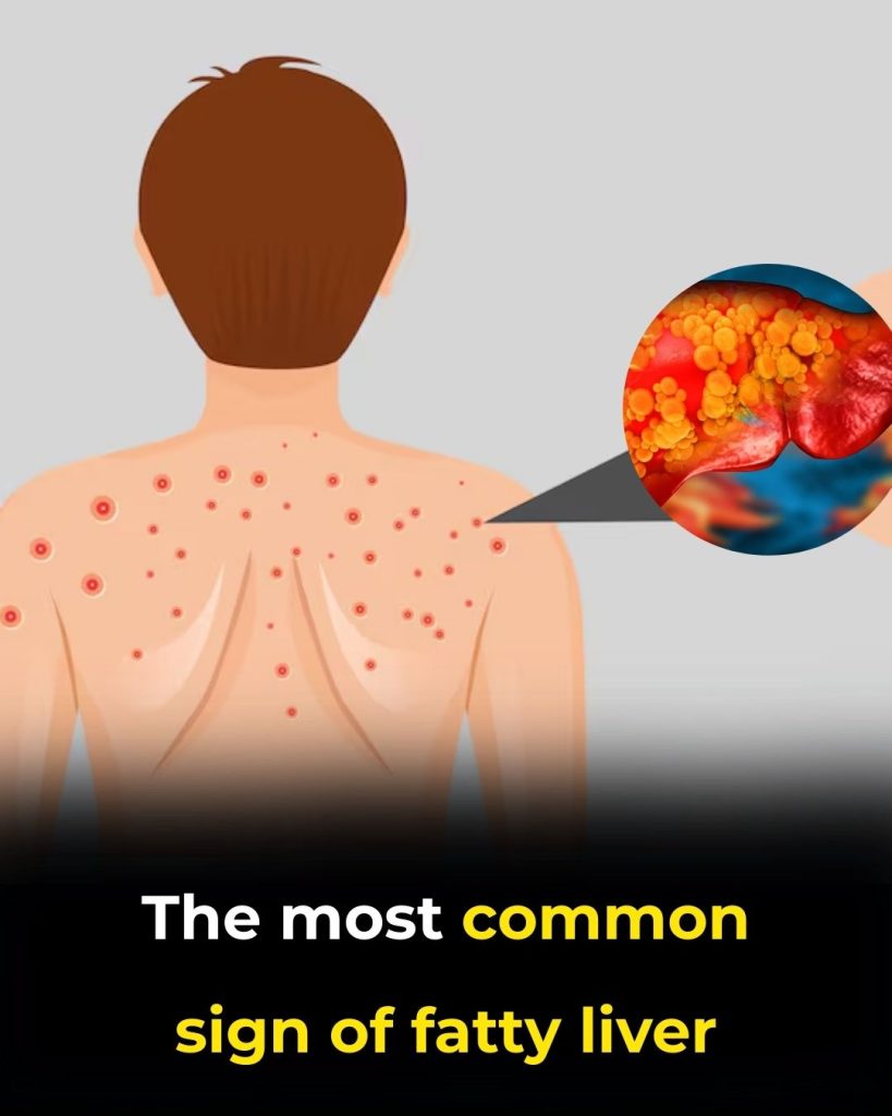 Fatty Liver: Causes, Symptoms, Treatment & Home Remedies