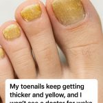 My toenails keep getting thicker and yellow, and I won’t see a doctor for weeks. What can I do right now?