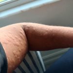 Noticing a new lump, bump, or unusual change on the skin