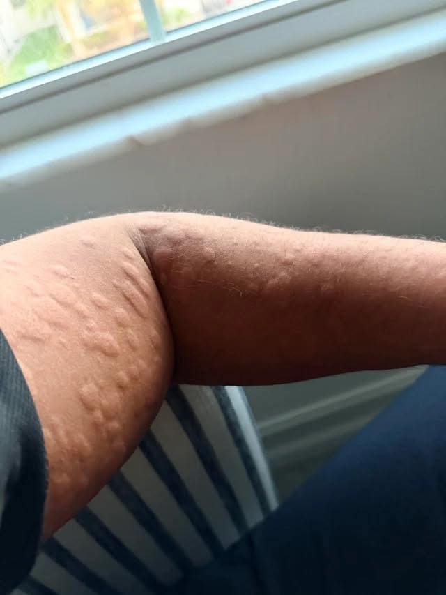 Noticing a new lump, bump, or unusual change on the skin