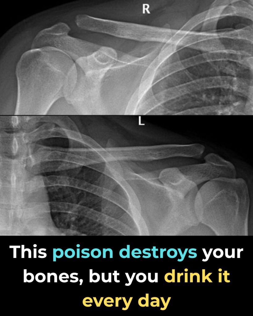 This Drink Will Destroy Your Bones From The Inside But Everyone Drinks It Anyway