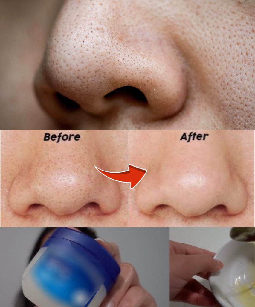 Remove blackheads on your nose with just a mixture of Vaseline and this cheap and easy-to-find ingredient