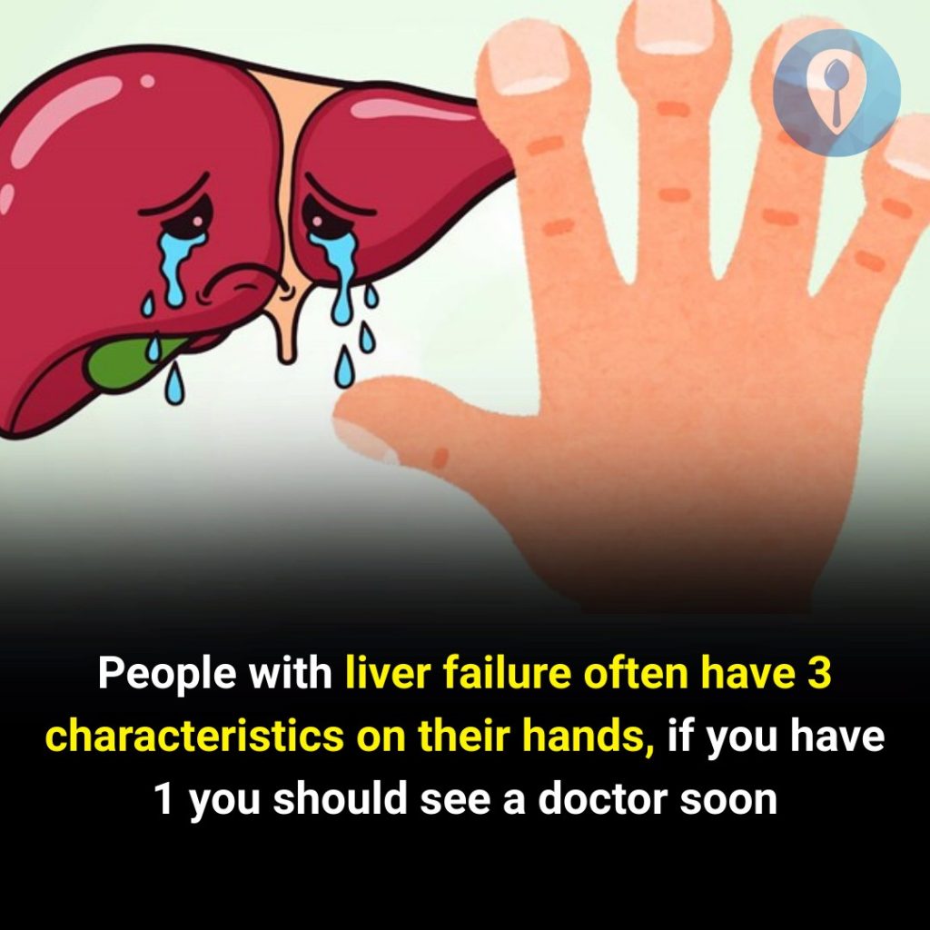 People with liver failure often have 3 characteristics on their hands, if you have 1 you should see a doctor soon
