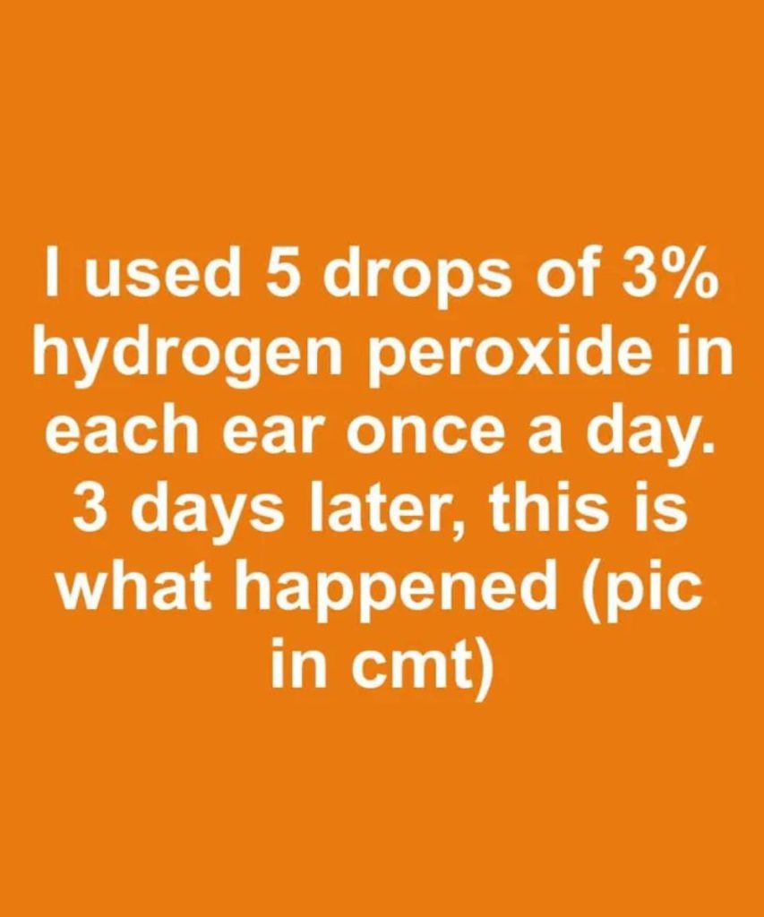 I used 5 drops of 3% hydrogen peroxide in each ear once a day. 3 days later, this is what happened