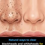 Natural Ways to Clear Blackheads and Whiteheads