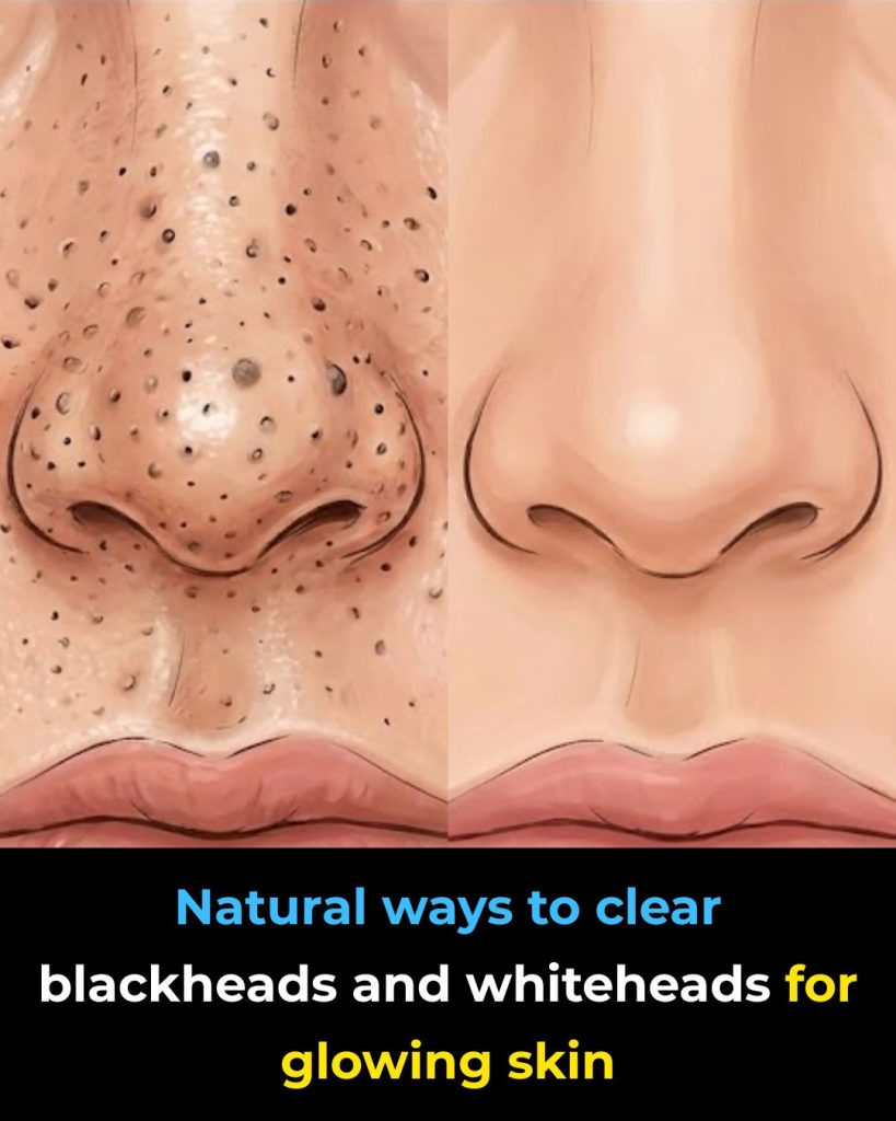 Natural Ways to Clear Blackheads and Whiteheads