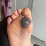 My daughter woke up with this huge spot on her foot I don’t know what it could be. She’s been in pain and can’t move her foot what is this.. Explain this